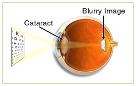 Diagram of cataract